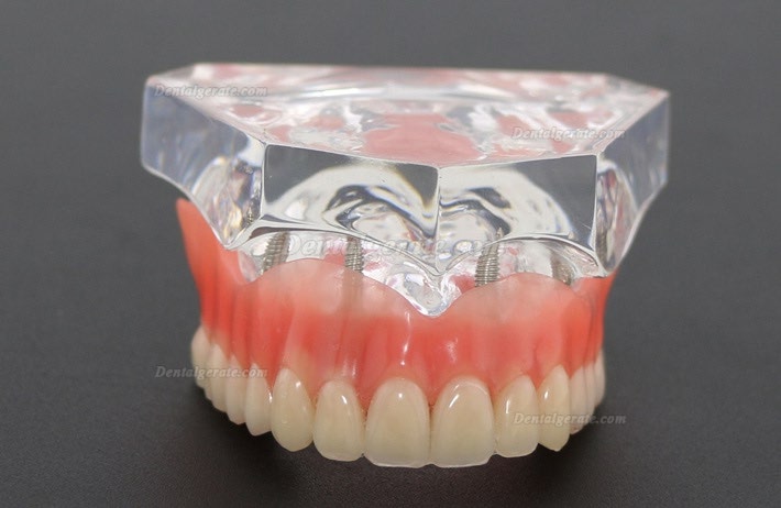 Anatomisches Modell der Zahnz&auml;hne &Uuml;berprothese Superior mit 4 Implantaten Demo Modell 6001